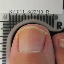 Successful Fungal Nail Treatment