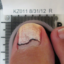 Toenail Fungus Before Treatment - Cold Laser Nail Clinic, Wairarapa