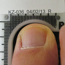 After Cold Laser for Fungal Toenail Infection