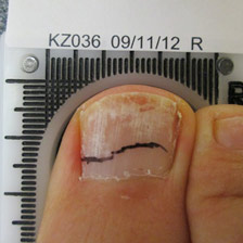 Fungal Toenail Infection Treatment in NZ