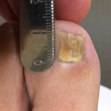 Toenail Fungus Before Treatment - Cold Laser Nail Clinic, Wairarapa