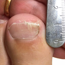 Toenail After Laser Treatment for Fungus