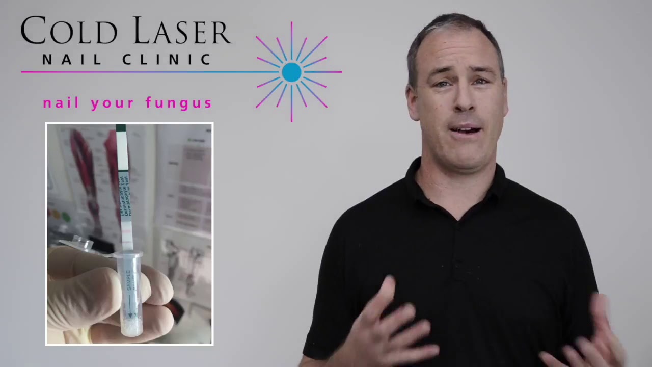 Cold Laser Treatment is the BEST Option for Fungal Nail Infections - YouTube